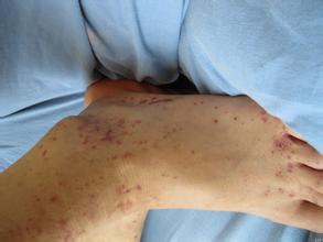 过敏性紫癜小红点会痒吗,不痛不痒的小红点是什么紫癜