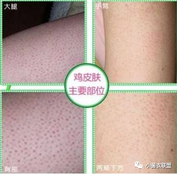 毛囊根部有凸起像鸡皮疙瘩痒,大腿毛囊有粉刺一样的疙瘩