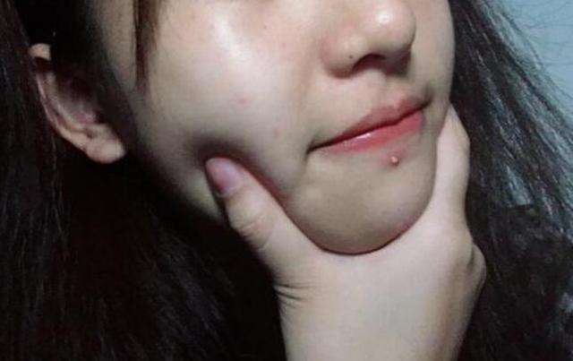 螨虫痘如何去除最高效,如何有效除螨虫痘