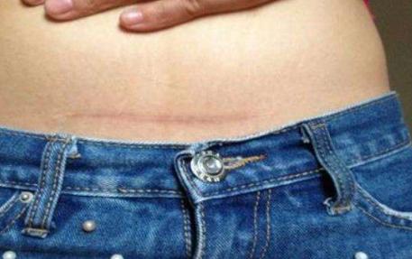 剖腹产后有后遗症怎么办,剖腹产之后会有哪些后遗症状