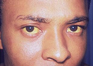 干扰素抗病毒的优缺点,你知道多少?