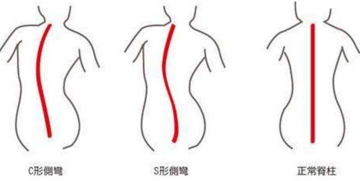 正美体态矫正脊柱侧弯真的有用吗,先天脊柱侧弯体态矫正有用吗