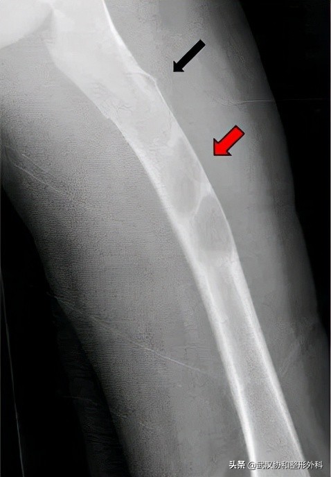 咖啡牛奶斑一定是神经纤维瘤吗,咖啡牛奶斑会突然出现吗