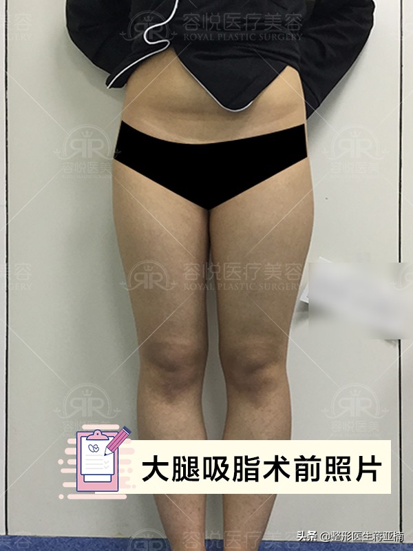 腰腹吸脂后凹凸不平多久恢复,大腿吸脂多久会出现凹凸不平