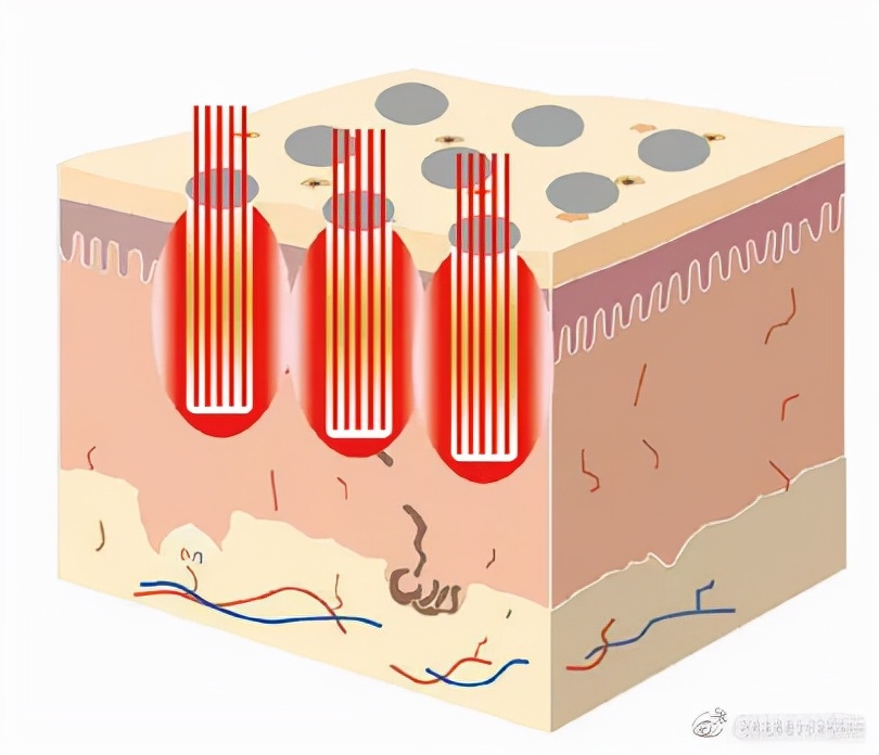 毛孔太粗大怎么收缩毛孔,毛孔越来越粗大的原因是什么