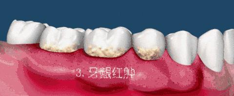 小米冲牙器伤牙,小米有品冲牙器头