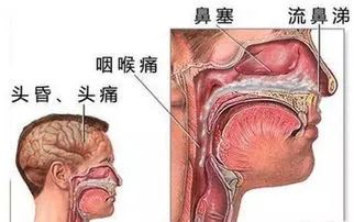 南阳医专一附院耳鼻喉科主任,南阳医院治鼻窦炎是什么手术