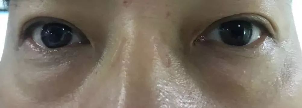 眼袋消除三个方法,教你一个简单消除眼袋的方法