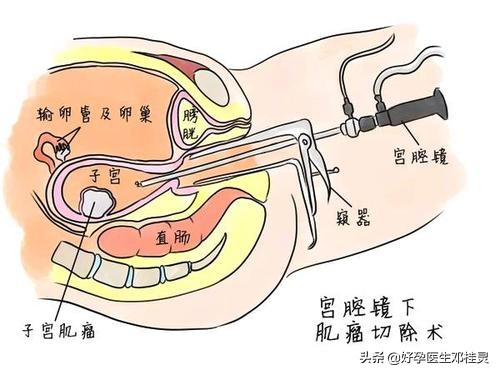 子宫内膜多发息肉宫腔镜能根除吗,子宫内膜异位症输卵管粘连不孕