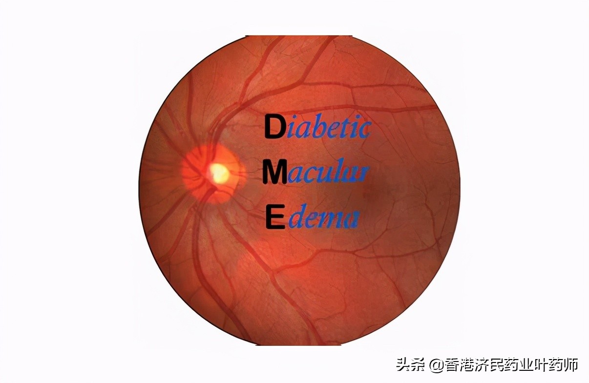 有临床意义的糖尿病黄斑水肿,糖尿病黄斑水肿研究进展