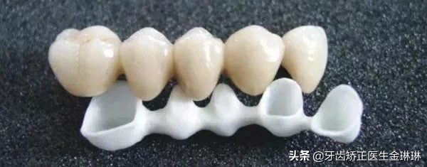 全瓷牙跟烤瓷牙哪种比较难拆掉,老人镶牙用全瓷牙好还是烤瓷牙