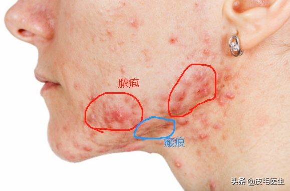 痘痘肌有效治理帮你轻松终结战痘,与痘痘和解与自己和解