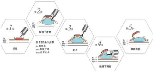 日照市中医医院成功开展直肠神经内分泌瘤ESD术