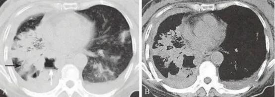 肺癌研究心得,我对癌症患者讲实话