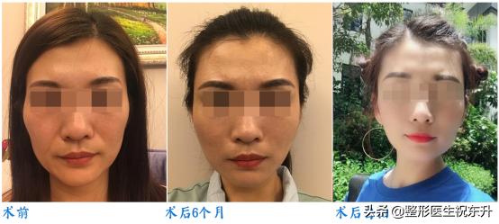 脸部皮肤松弛怎么办？不一定要“去皮”，平时这样保养