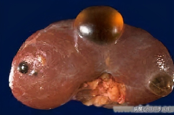 体检有肝囊肿要不要治疗,体检有肝囊肿需怎样解决