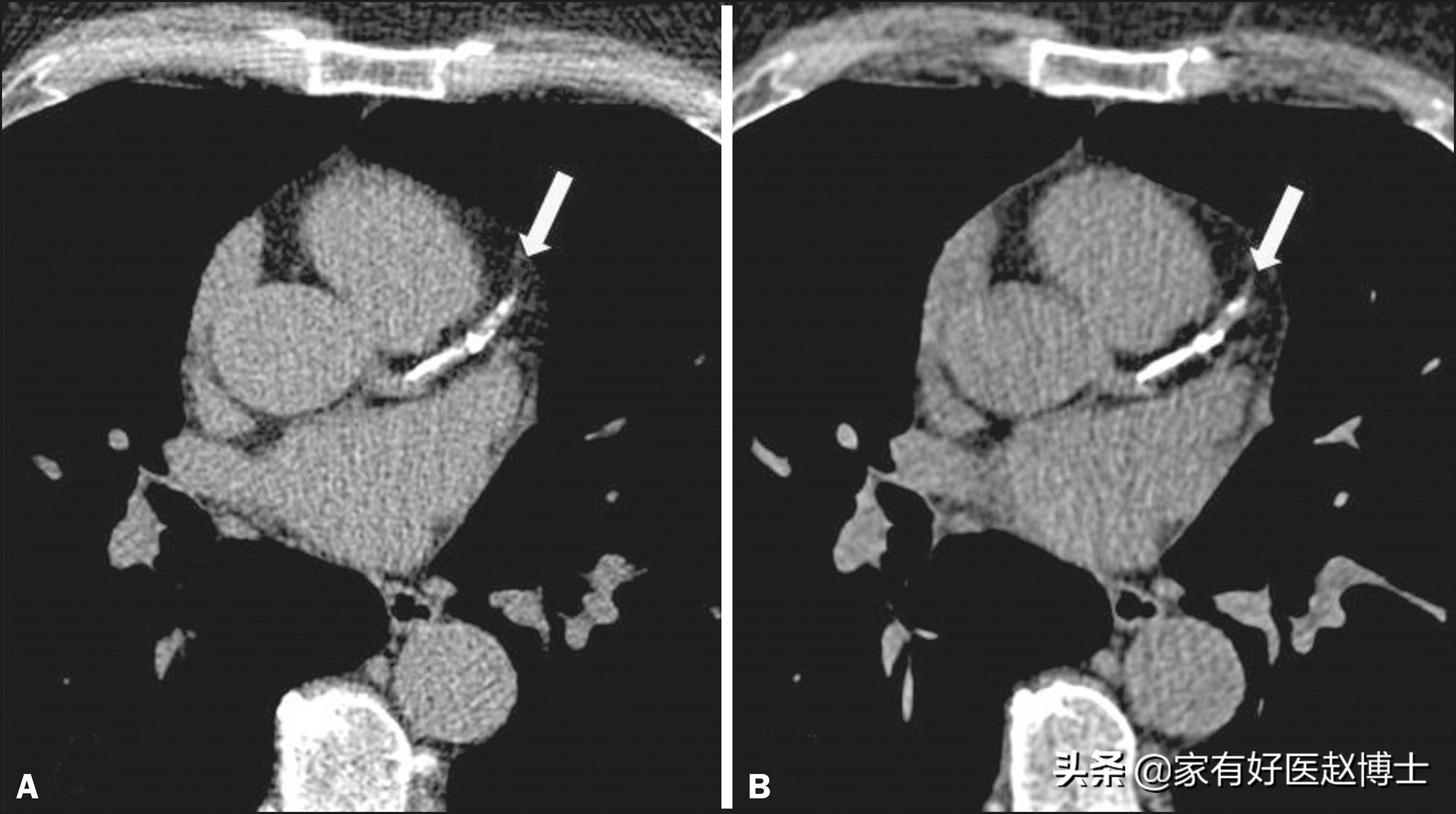体检显示部分脑动脉钙化,体检查出了动脉斑块有何危害