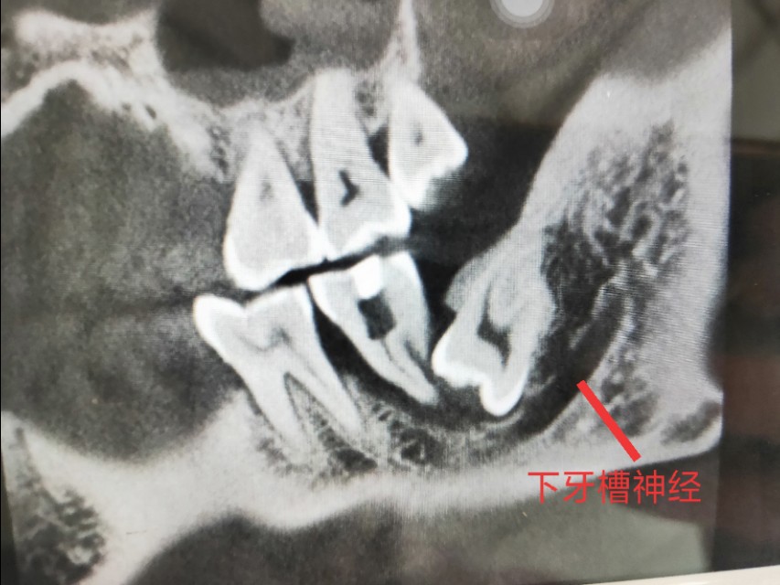 拔牙，就是简单的将牙齿扯出，真是这样吗？|口腔医生：拔牙无小事