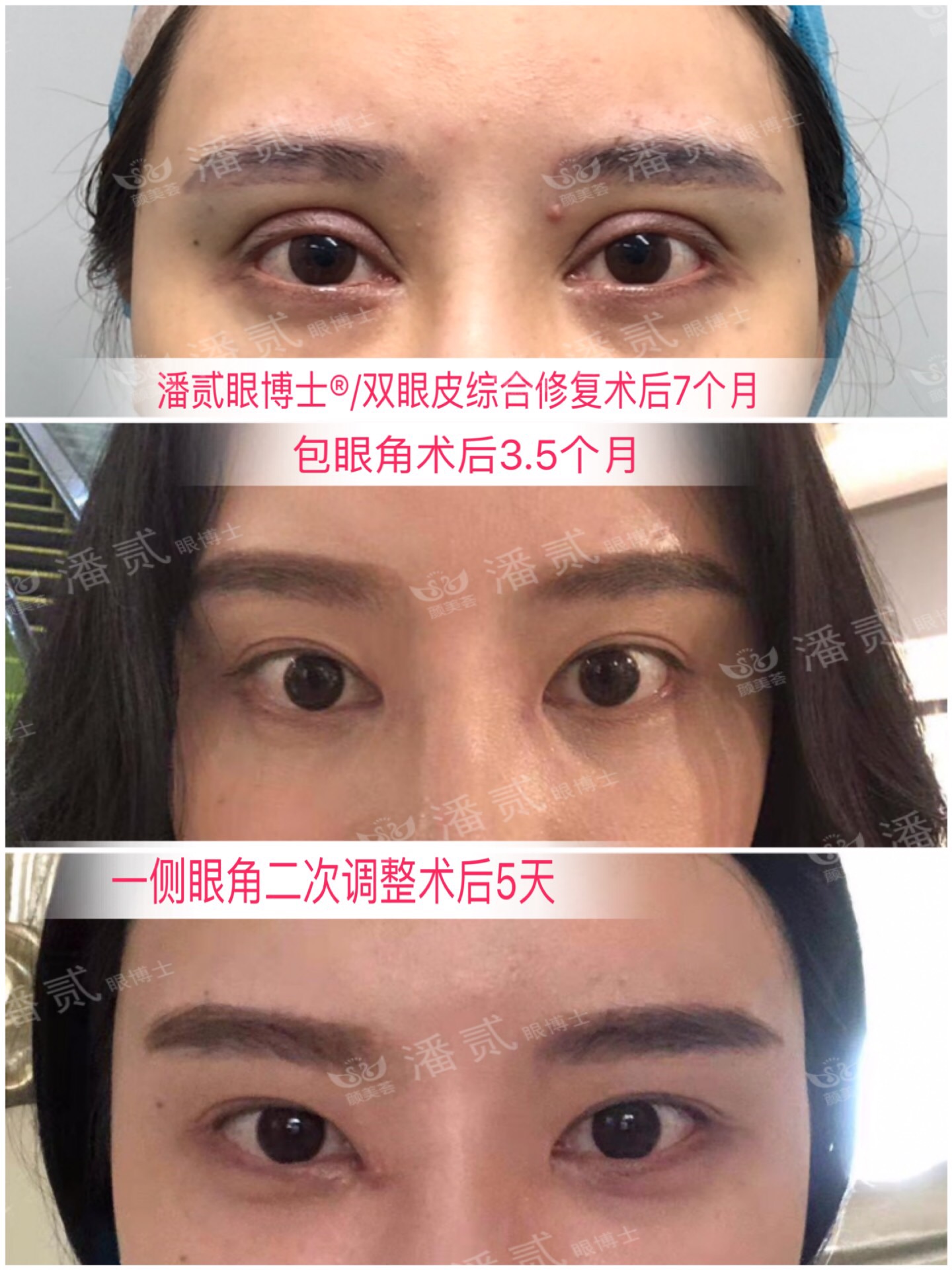 开内眼角会留疤的照片,开内眼角的疤痕变白色了怎么办