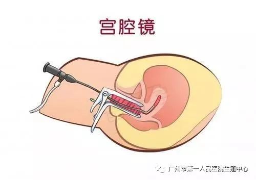 反复流产需要做输卵管检查嘛,宫腔粘连反复流产