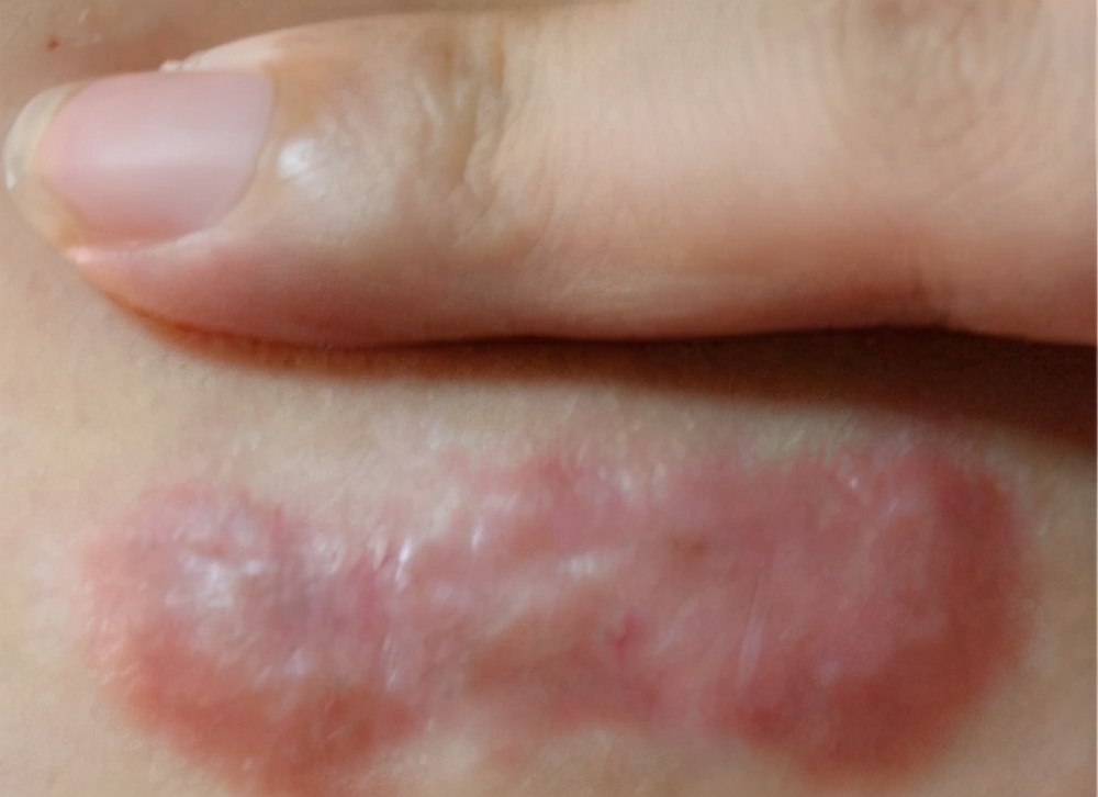 疤痕增生变软了是快好了吗,增生疤变软