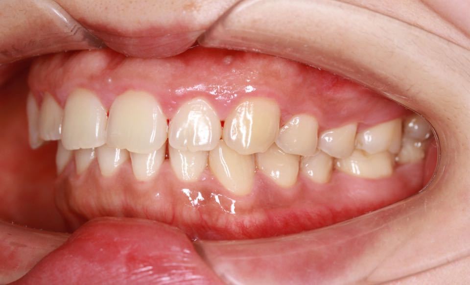 西安张军正畸医生如何,西安牙齿矫正案例