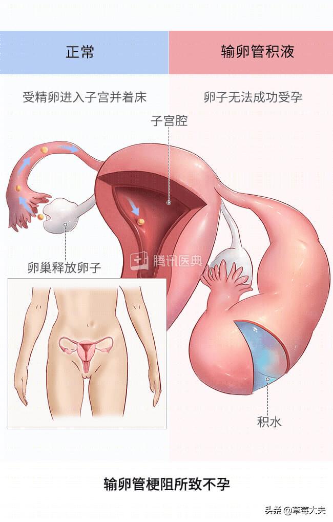 医生也成“催生婆”？不！是你输卵管出问题了......