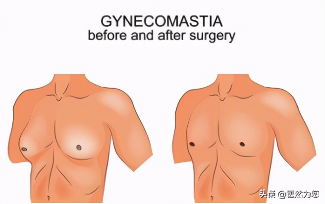 甲亢会老得快吗,吃甲亢药脖子为什么会变大