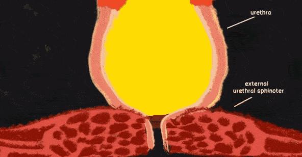 我为何尿路感染总是治不好？原因在这