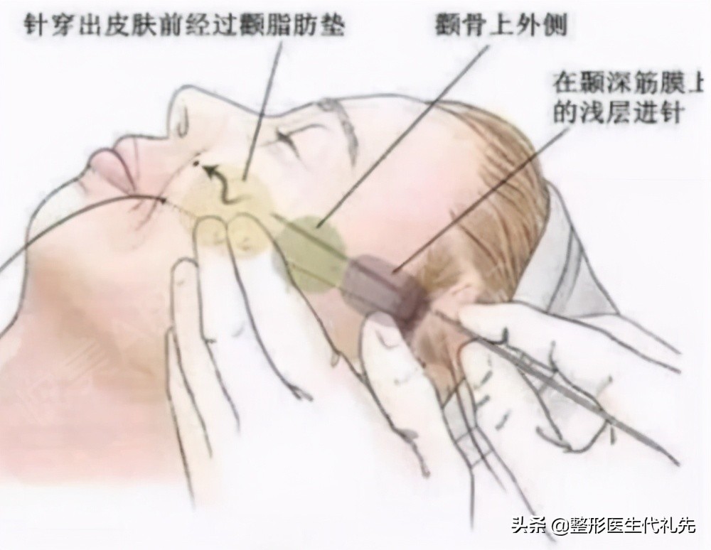 做线雕和不做线雕的好处,面部线雕能改善下颌线吗