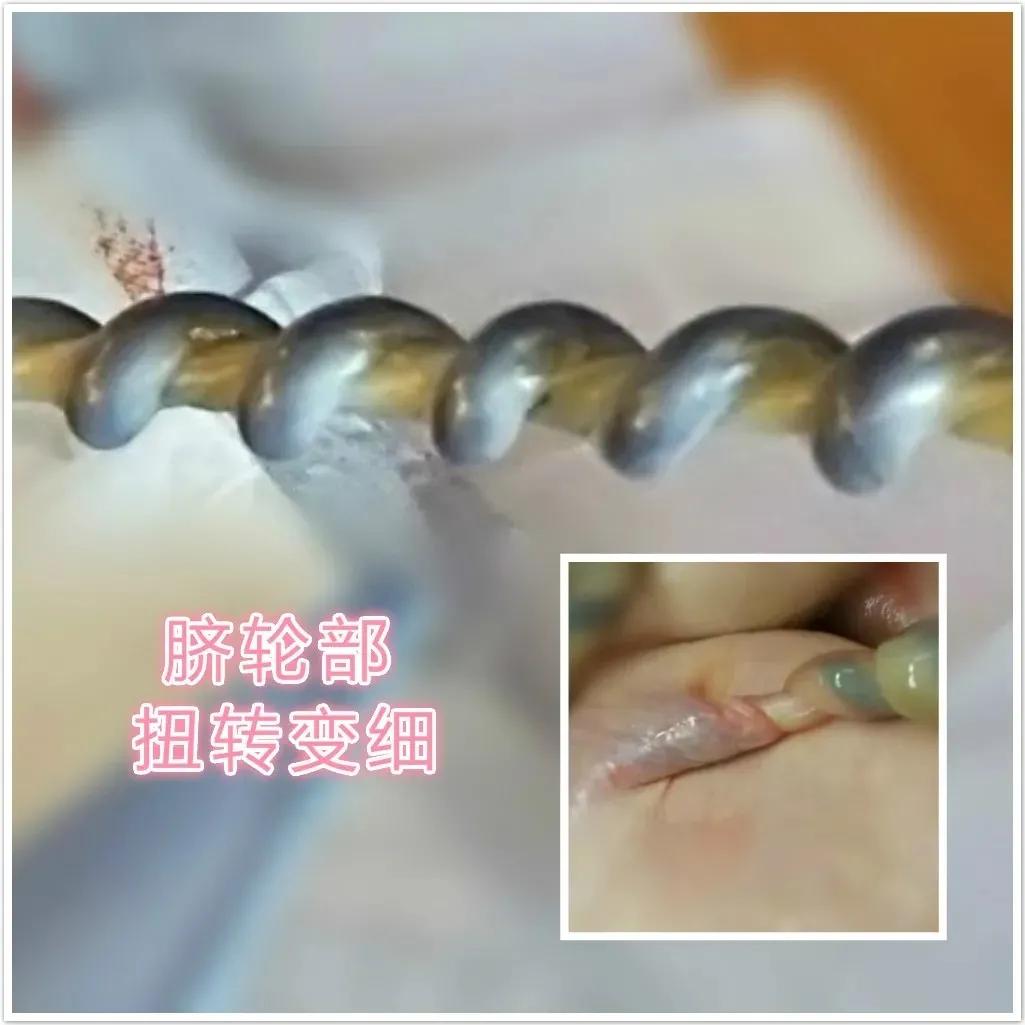 产妇胎心骤降胎儿命悬一线,产妇胎儿宫内窘迫抢救措施