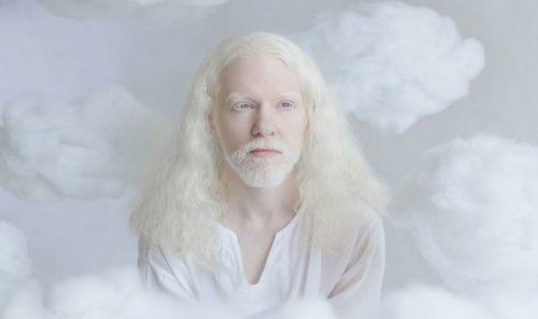 缺少黑色素但不是白化病,体内黑色素过少会引起白化病吗