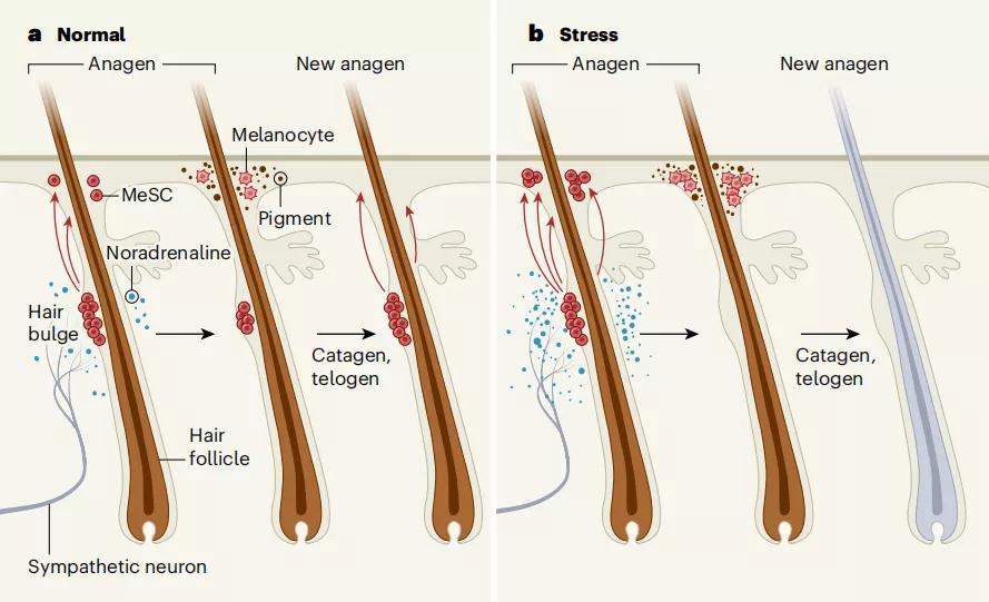 一夜白头是有心事吗,一夜白头是真实案例吗