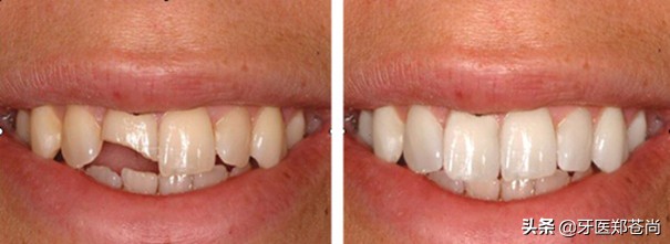 牙齿断裂了怎么修复？患者是前牙断裂