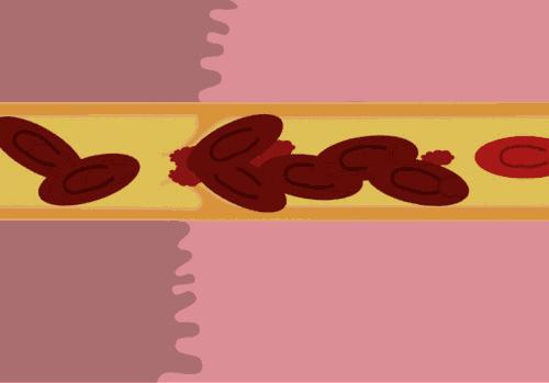 血管堵塞到什么程度需放入支架,血管堵了就是什么能力下降了