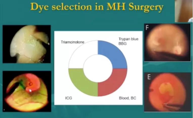 视网膜裂孔未来有希望痊愈,眼底黄斑裂孔能治愈吗最新消息