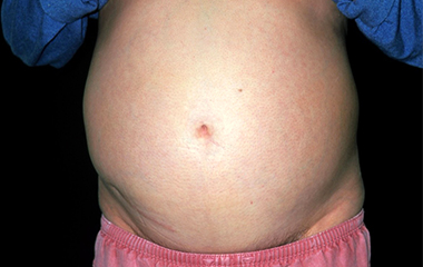 肝癌晚期出现腹水怎么办？肝癌晚期有腹水还能活多久？