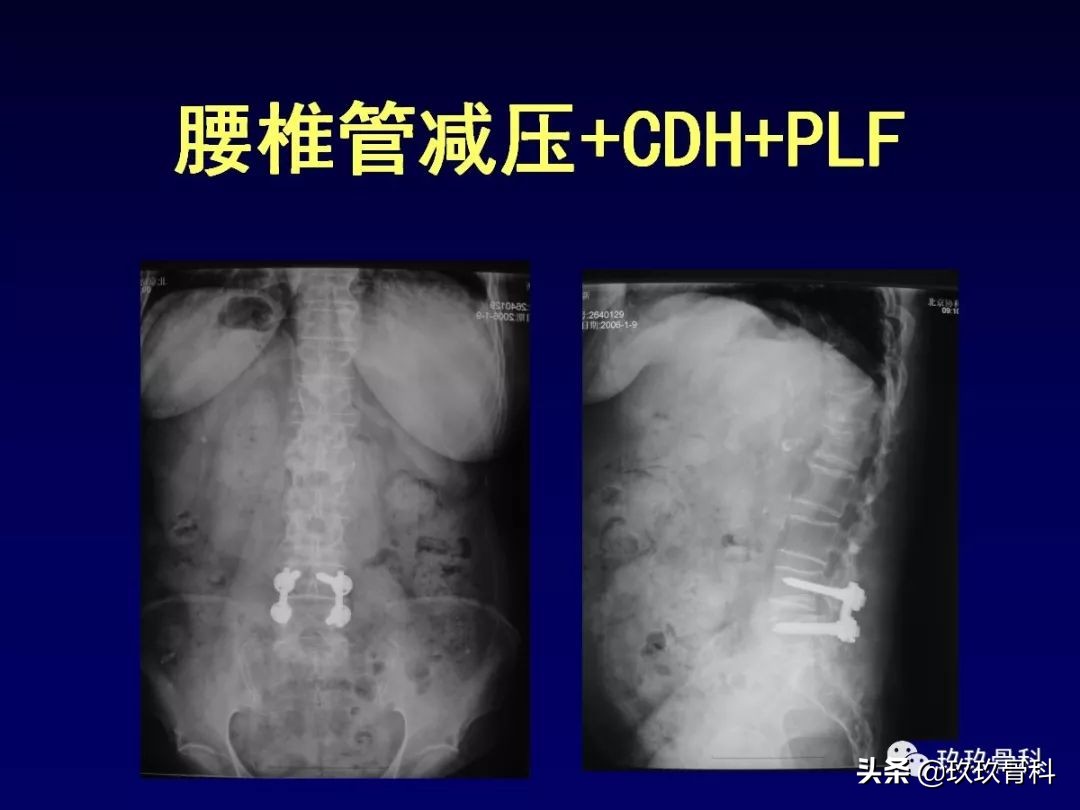 腰椎不稳最坏的结果,腰椎不稳的最佳治疗方法