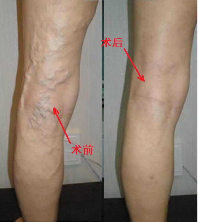 看过来，看过来！静脉曲张与静脉血栓到底有什么区别和联系？