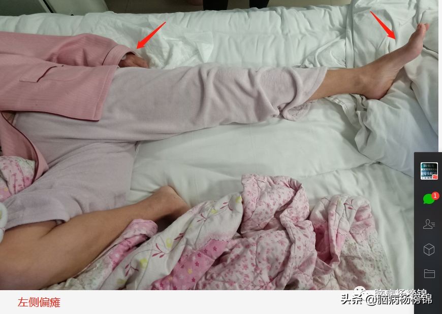 脑梗塞病人拉肚子怎么办,感冒会引起脑梗头晕的加重吗