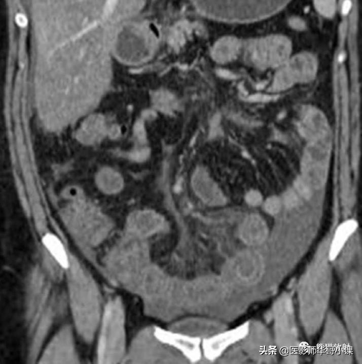 「精品课件」11种腹膜感染/炎症性病变的影像学表现