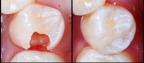 门牙补牙用什么材料最好,补牙的材料选哪种更好