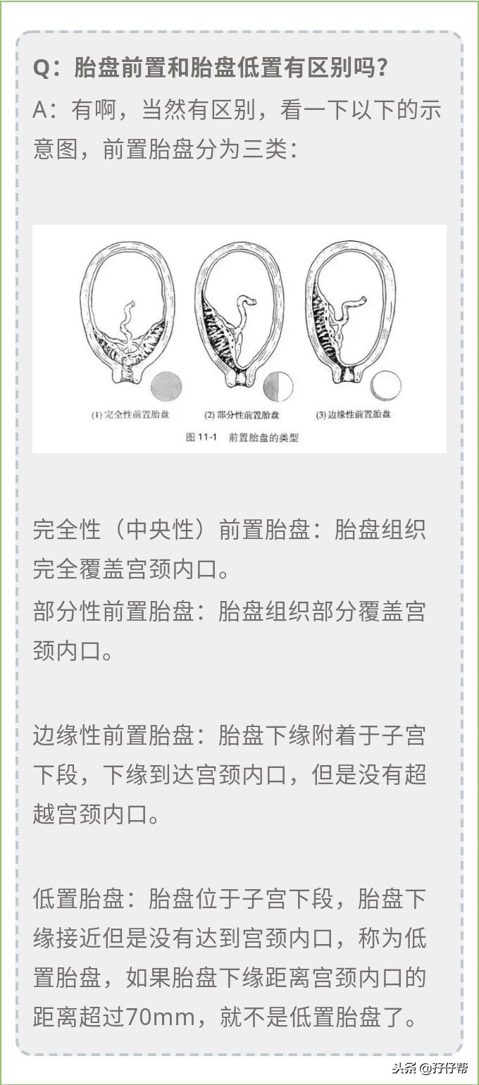 胎盘低要卧床吗,胎盘低置没什么反应就没事吗