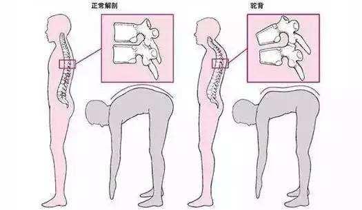 女性绝经后骨质疏松怎么办,绝经后骨质疏松一般在几年