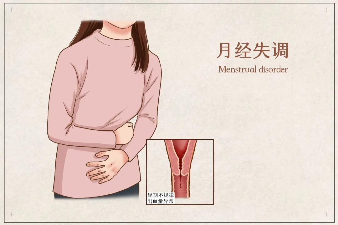 50岁子宫肌瘤怎么办,怀孕有子宫肌瘤怎么办