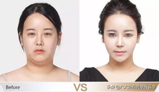 下巴脂肪堆积的解决方法,下巴脂肪过多怎么办