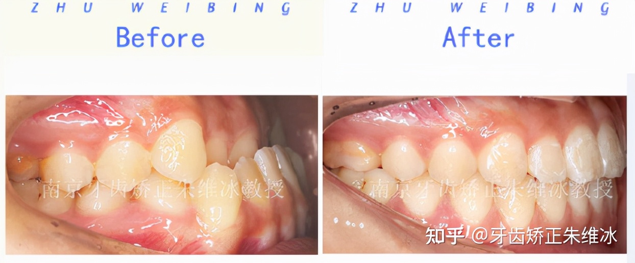 南京透明式牙齿矫正器地包天,18岁功能性地包天能改善面型吗