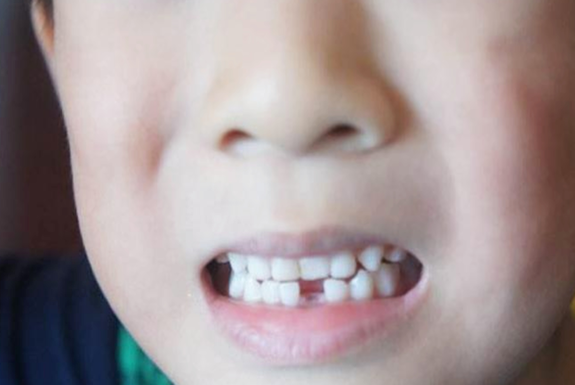 宝宝掉牙了应该怎么处理,宝宝掉牙了怎么办小视频