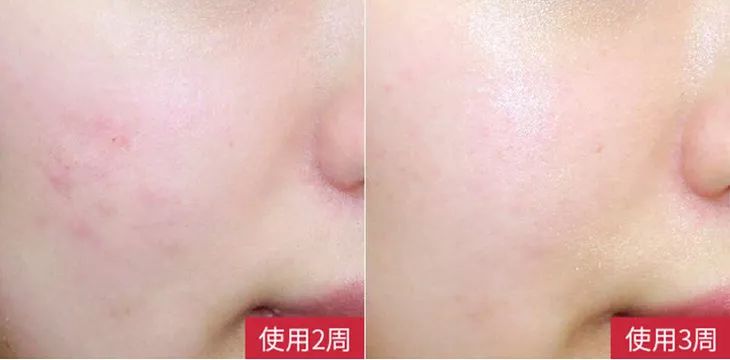 李湘直播间推荐祛痘,李湘推荐美容仪小v脸