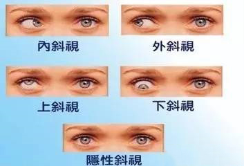 高度近视眼睛斗鸡眼怎么办,近视眼成斗鸡眼了怎么办